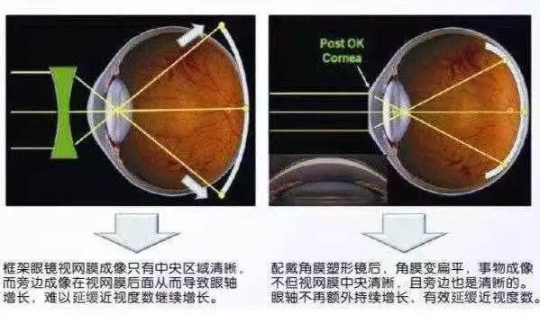 什么是角膜塑形镜可以治疗近视吗