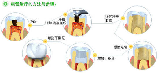 根充剂的作用