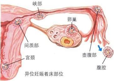 子宫肌瘤多大需要手术