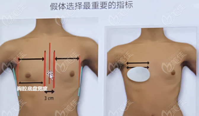 假体隆胸三个月了还隐隐作痛