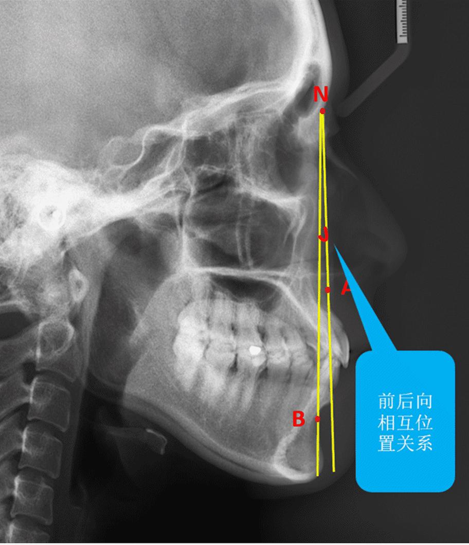 x光片怎么扔掉