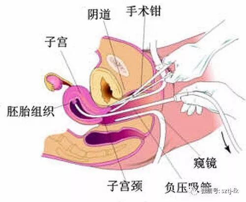 流产无痛手术怎么做,流产无痛手术解析与实效设计计划,最新分析解释定义_MP72.92.20