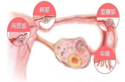 治疗输卵管堵塞需要多少价格,关于治疗输卵管堵塞的费用及深层设计解析策略,现状解答解释定义_专属款42.44.19