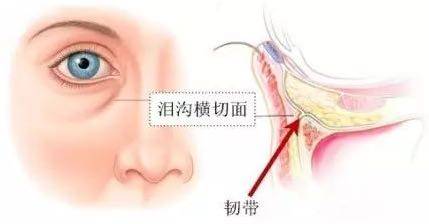 泪沟太深怎么改善