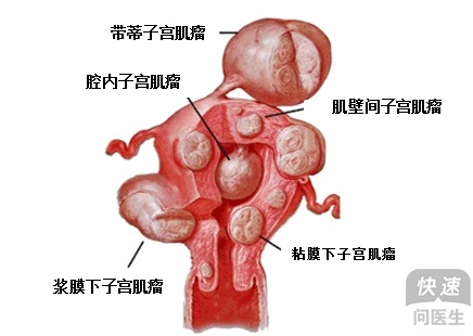 子宫肌瘤手术费用大概多少