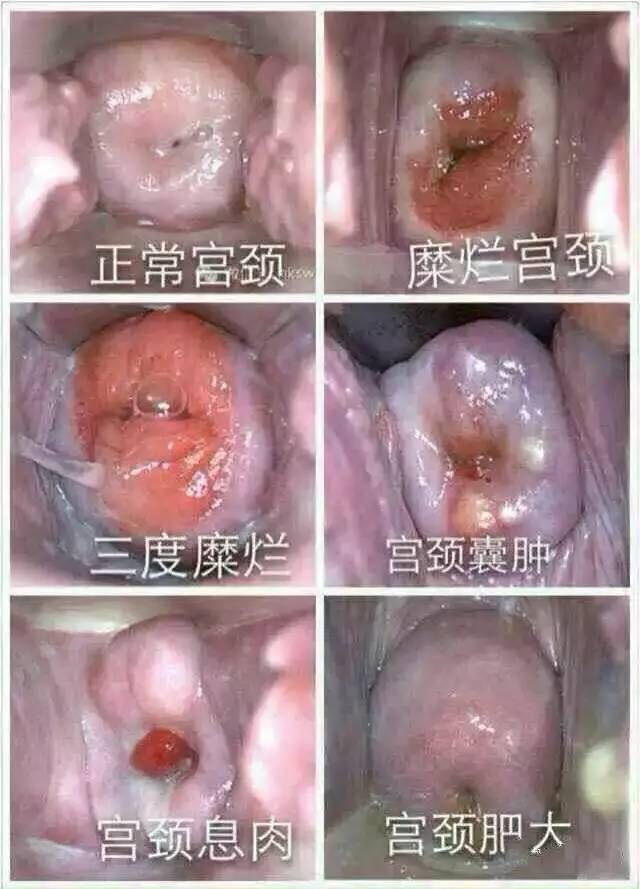 未婚宫颈糜烂是什么原因引起的