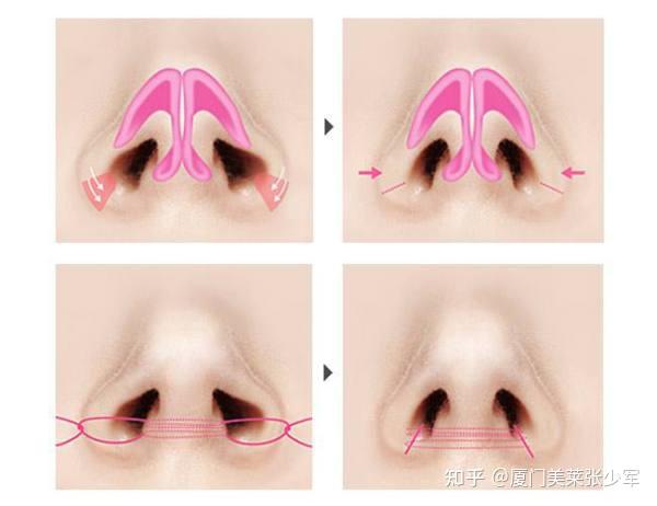 隆鼻后修复能不能单做缩鼻翼