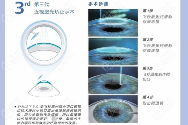 激光近视手术的后遗症有哪些