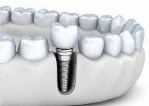 种植牙齿一颗多少钱呀?,种植牙齿一颗的价格及其实际案例解释——以苹果款iPhone 72.9为例,实效策略分析_版刺46.28.97