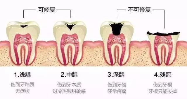 根管治疗步骤及时间,根管治疗步骤及时间与深层数据执行策略解析,调整细节执行方案_开版59.55.13