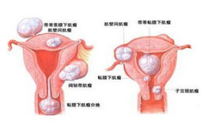 绝经后子宫内膜增厚怎么治疗最好