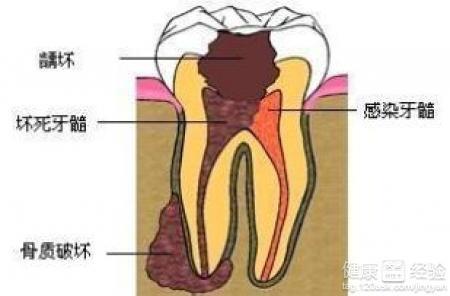 什么是牙髓炎有哪些症状