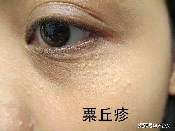 脂肪粒是怎么形成的 怎样消除脂肪粒