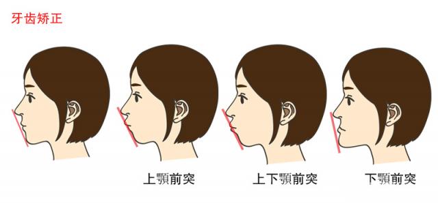 骨性龅牙怎么矫正